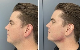 Jaw Surgery Cost before and after