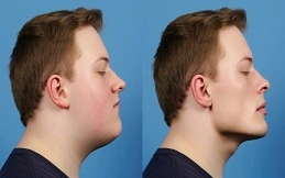 Jaw Surgery Cost before and after