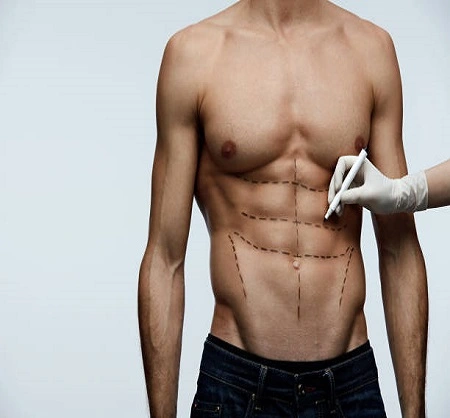 Six Pack Abs Surgery in Dubai