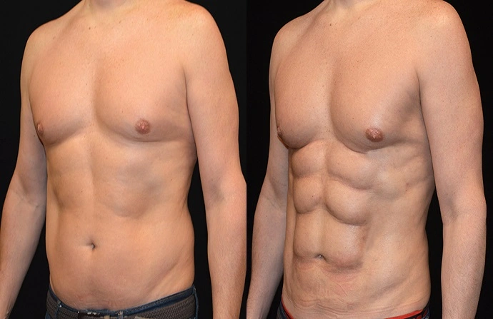 Six Pack Abs Surgery before and after