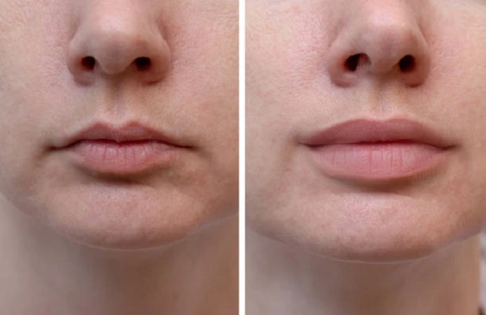 Volulift Fillings before and after