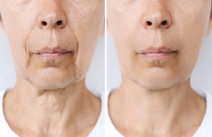 Volulift Fillings before and after