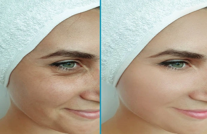 Volulift Fillings before and after