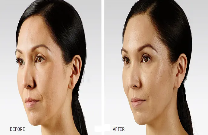 Voluma Fillers before and after