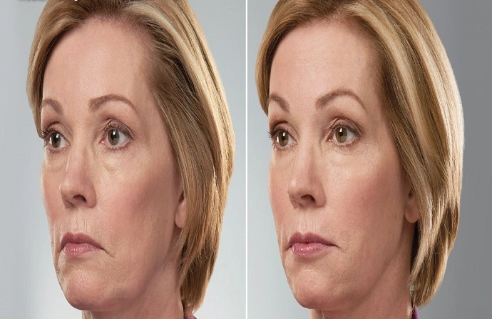 Voluma Fillers before and after