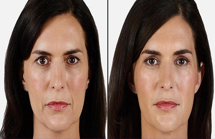 Voluma Fillers before and after