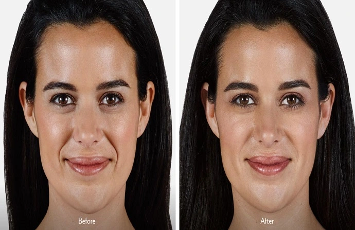 Voluma Fillers before and after