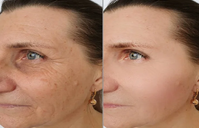 Aquagold Injection before and after