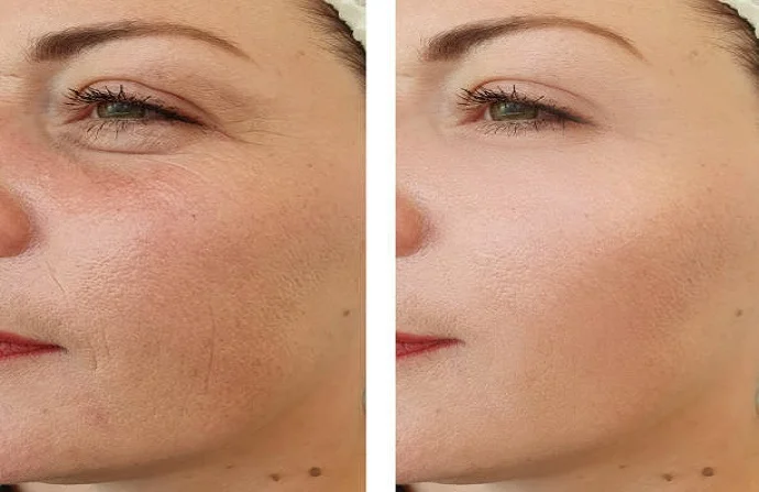 Aquagold Injection before and after