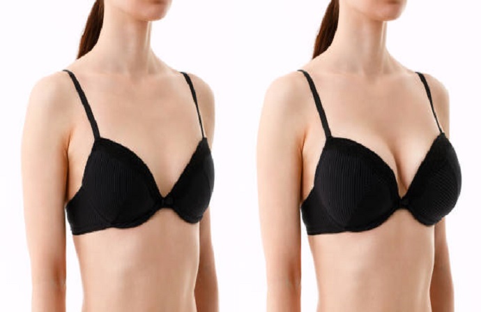 Breast Lift before and after