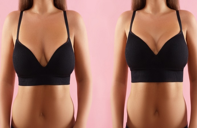Breast Lift before and after