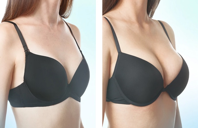 Breast Lift before and after