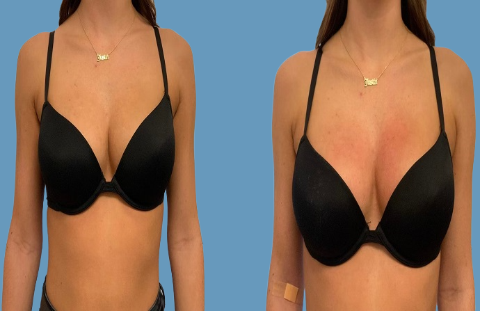 Breast Lift before and after