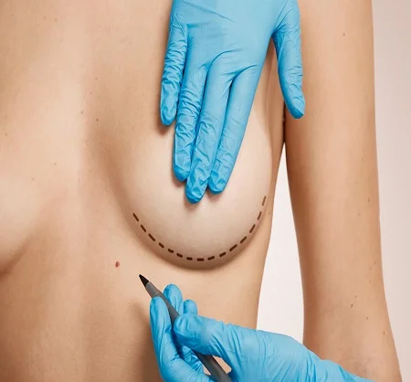 Breast Reduction in Dubai