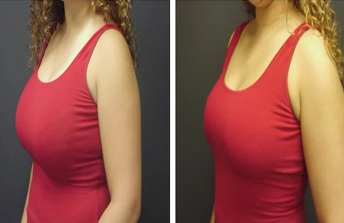 Breast Reduction before and after