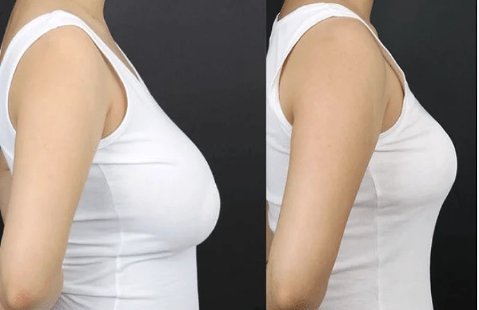 Breast Reduction before and after