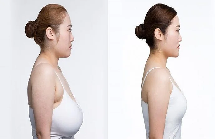 Breast Reduction in Dubai