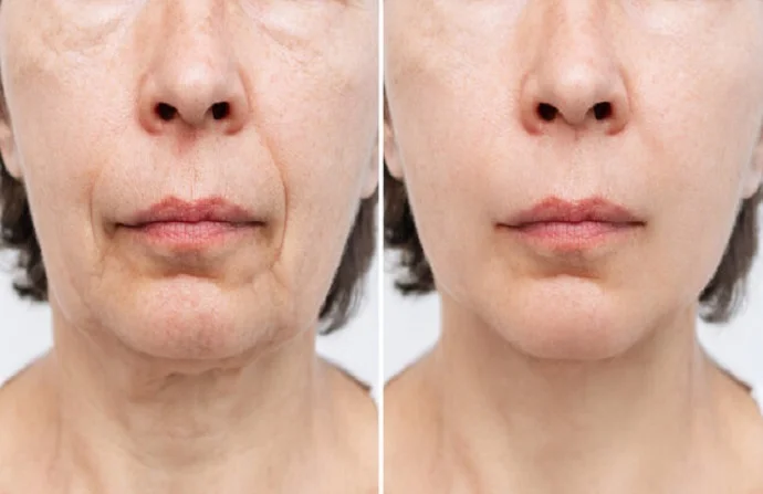 Endolift Treatment before and after