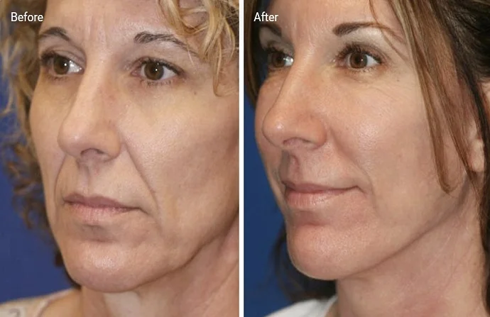 Endolift Treatment before and after
