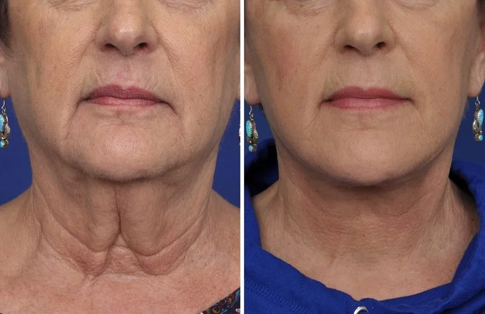 Endolift Treatment before and after