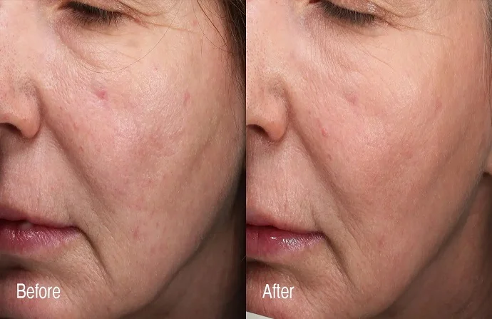 Fractional RF Microneedling before and after