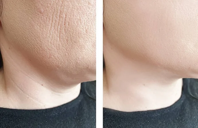 Fractional RF Microneedling before and after
