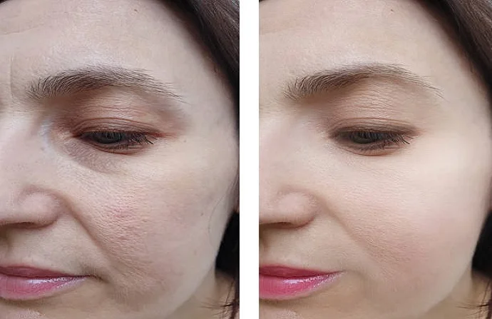 Fractional RF Microneedling before and after