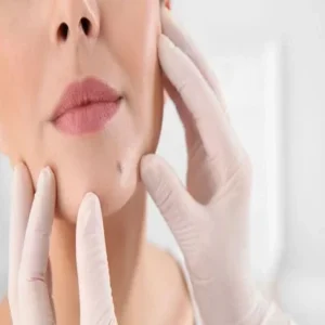 Mole Removal Cost in Dubai