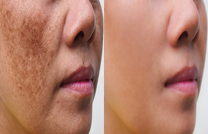 Skin Pigmentation Before and After