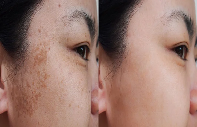 Skin Pigmentation Before and After
