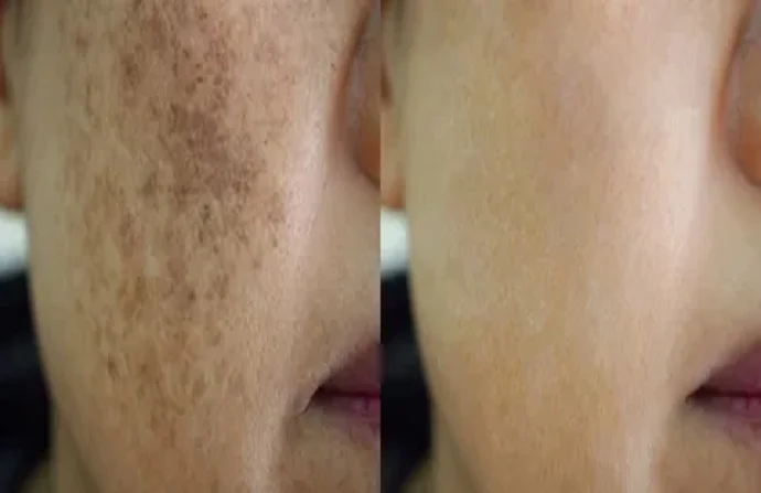 Skin Pigmentation Before and After