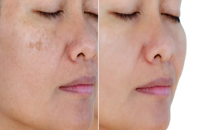 Skin Pigmentation Before and After