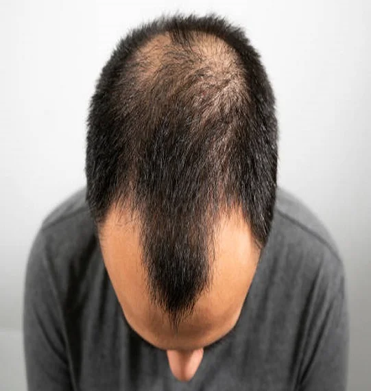 Stem Cells Hair Transplant in Dubai