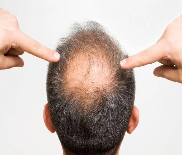 Stem Cells Hair Transplant in Dubai