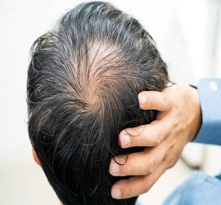 Stem Cells Hair Transplant in Dubai