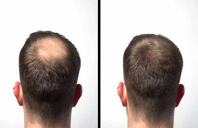 Stem Cells Hair Transplant Before and After