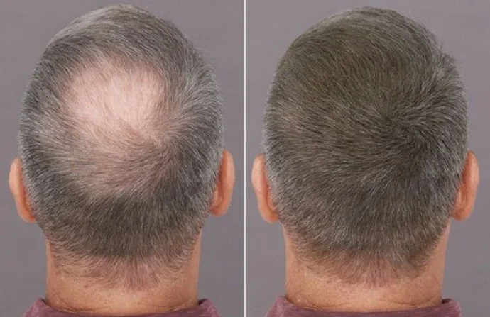 Stem Cells Hair Transplant Before and After