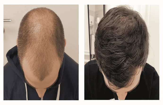 Stem Cells Hair Transplant Before and After