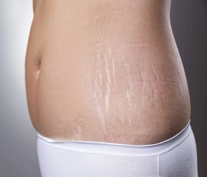Stretch Mark Removal in Dubai
