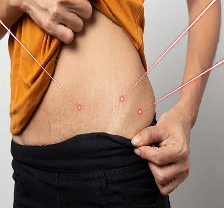 Stretch Mark Removal in Dubai