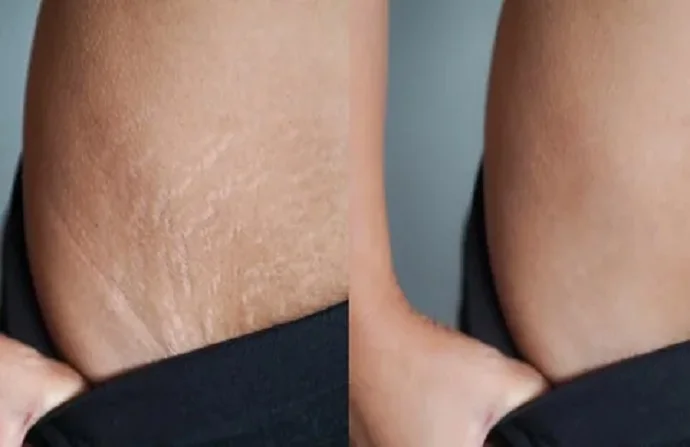 Stretch Mark Removal before and after