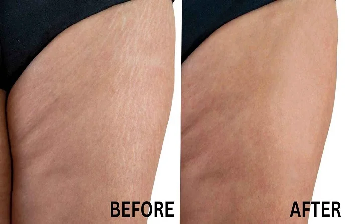 Stretch Mark Removal before and after