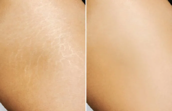 Stretch Mark Removal before and after