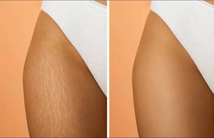 Stretch Mark Removal before and after