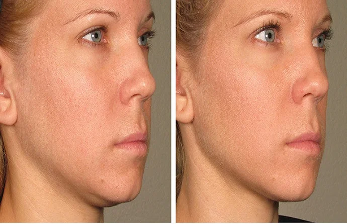 Ultertherapy Treatment before and after