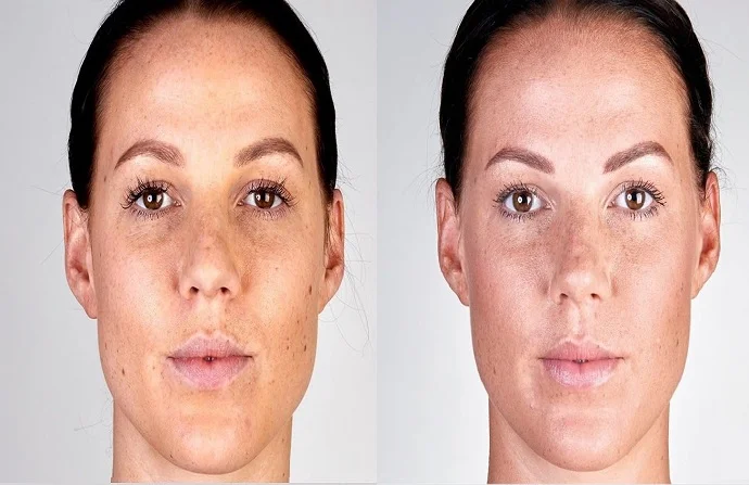 Ultertherapy Treatment before and after