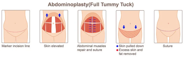 Abdominoplasty (Full Tummy Tuck)