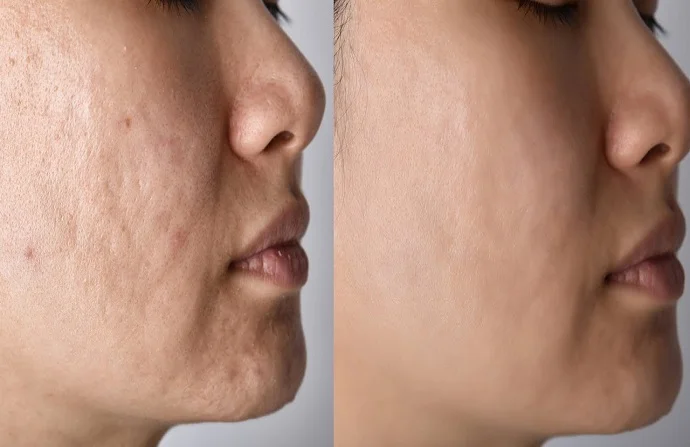 Acne Scar Treatment before and after