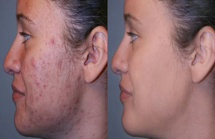 Acne Scar Treatment before and after