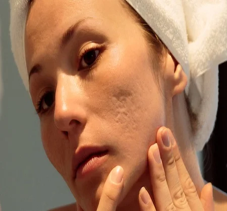 Acne Scar Treatment in Dubai